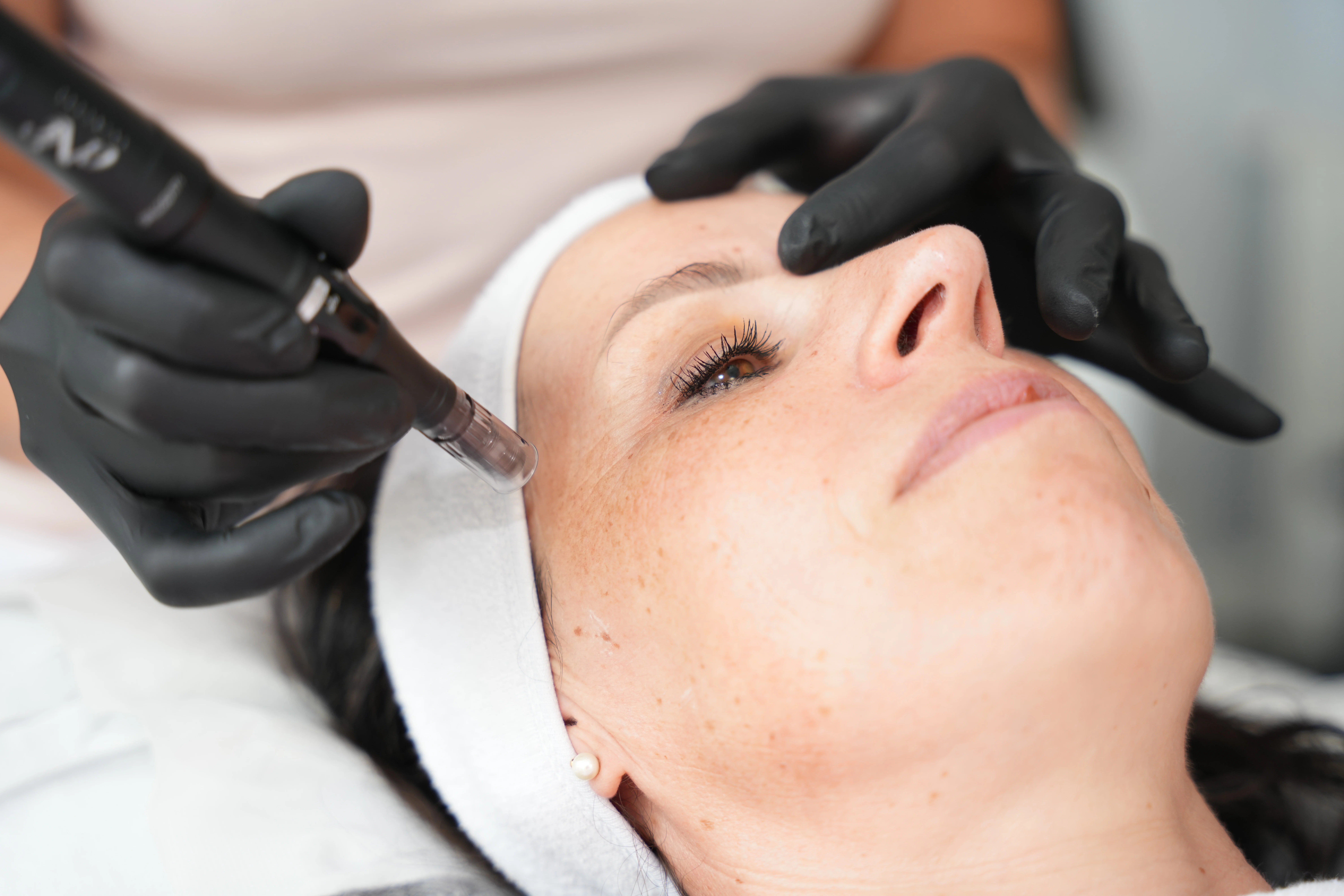 Microneedling Anti-Aging Behandlung