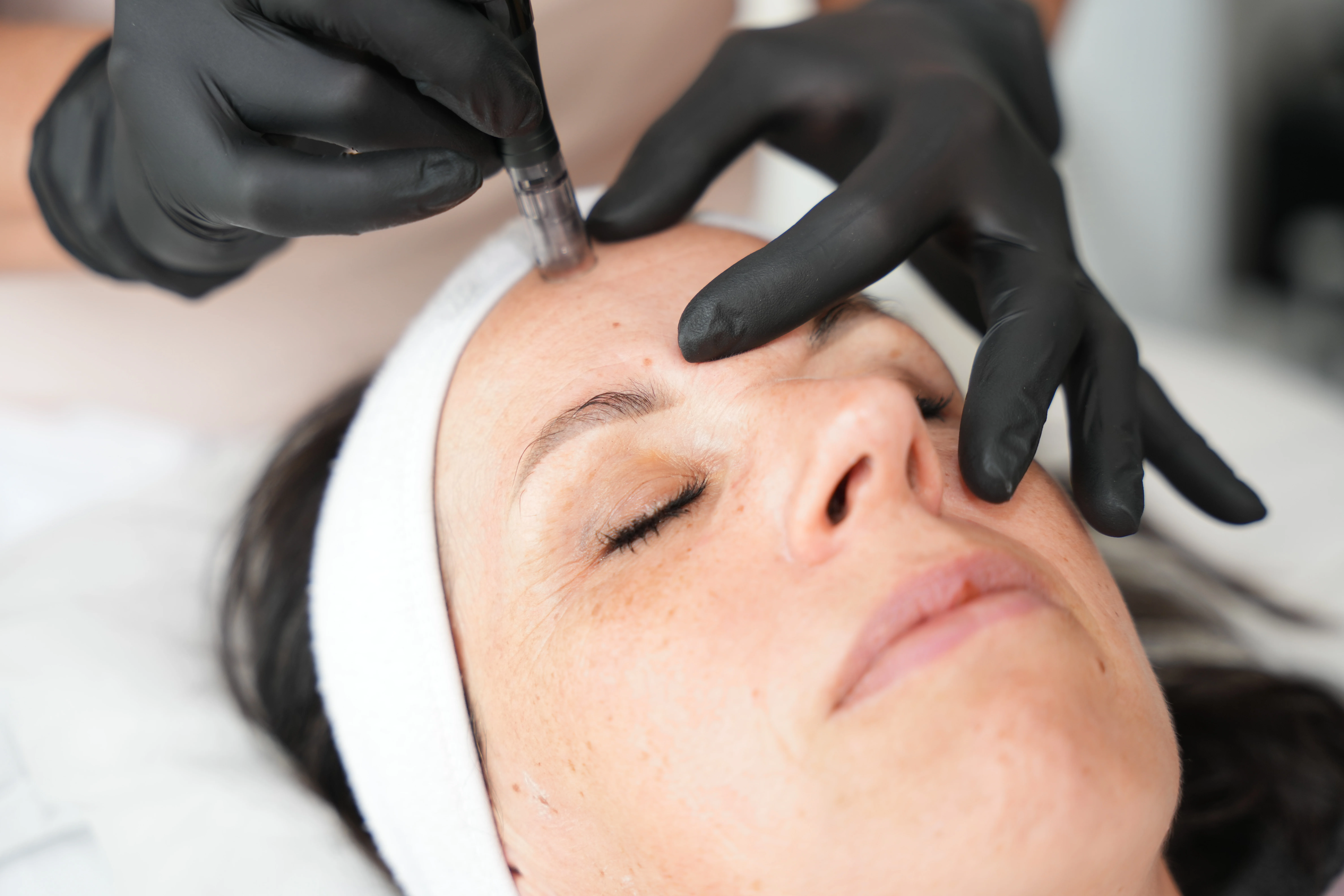 Microneedling Behandlung Detailansicht