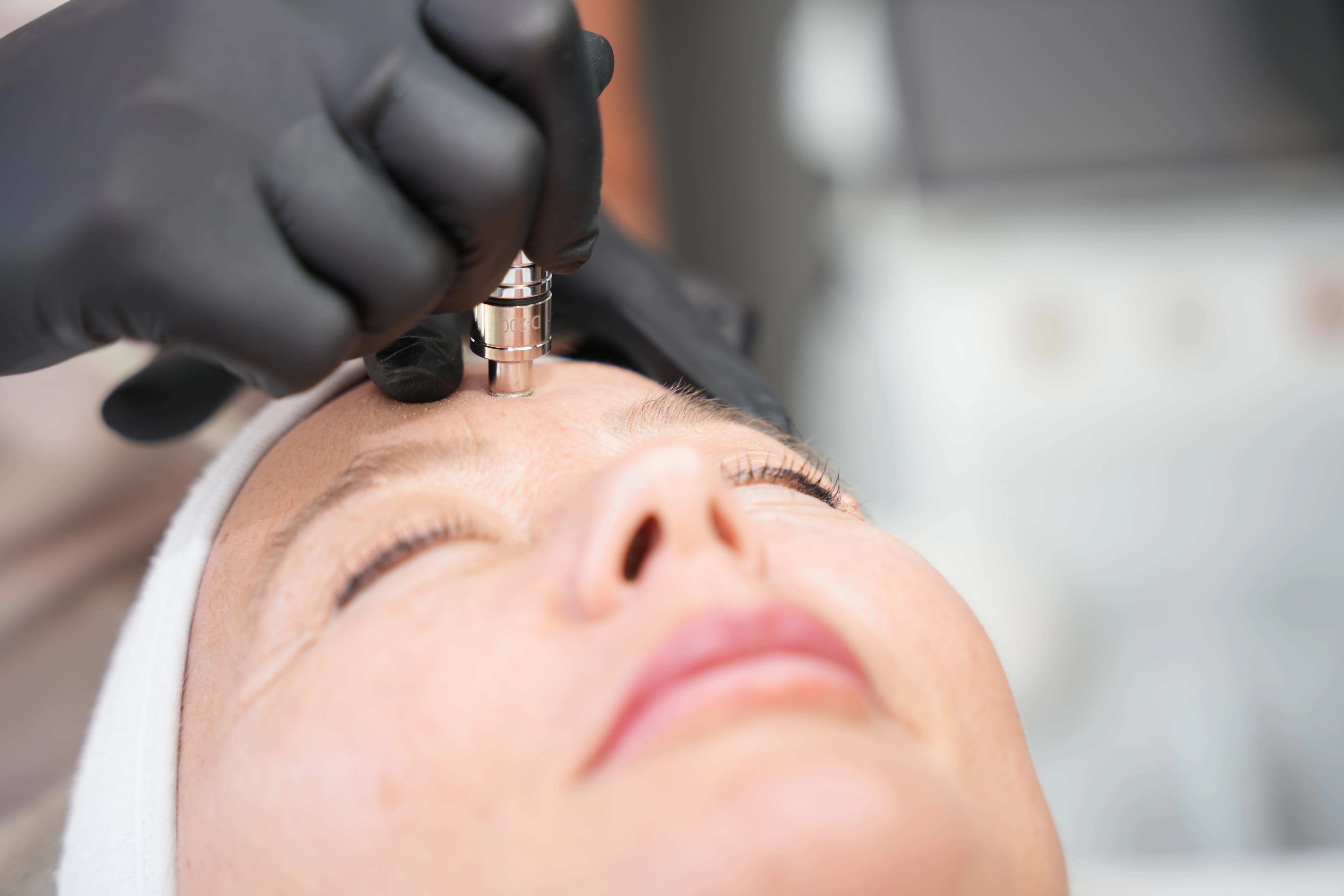 Microneedling Nahaufnahme Haut Heilbronn